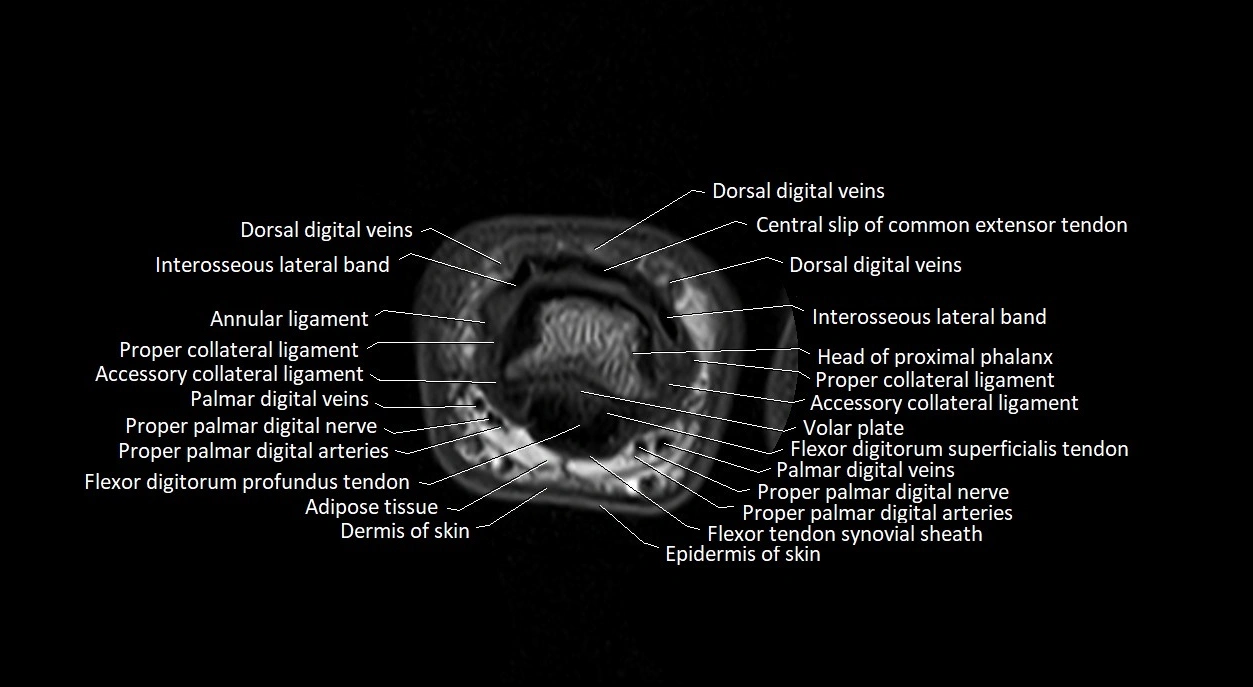 Finger anatomy axial cross sectional 3T image image 13.webp
